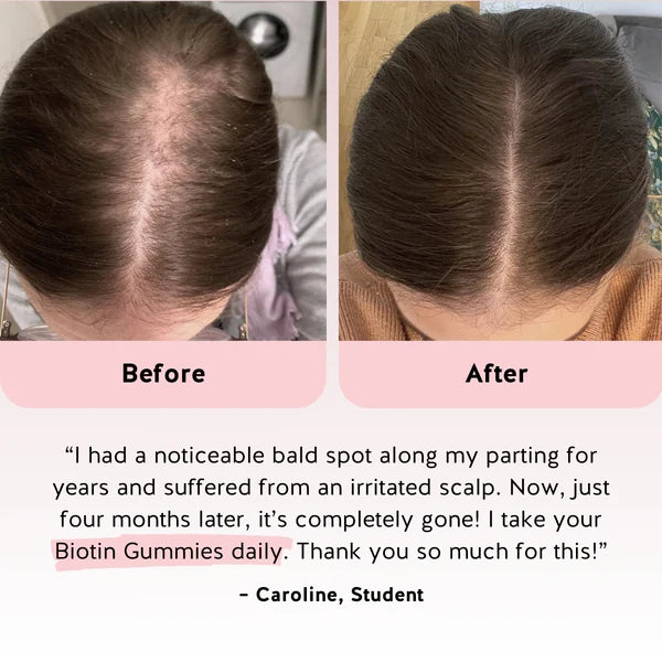 Biotin Hair Gummies: Reduce Hair Loss & Support Stronger, Healthier Growth